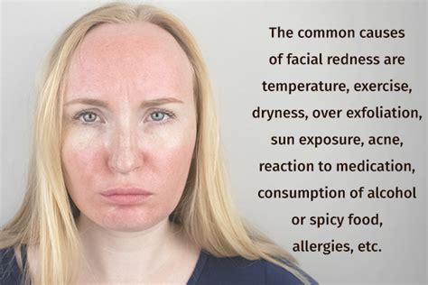 How To Cure Redness On Face 6 Home Remedies And Treatment
