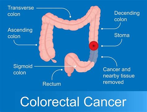 Why Colonoscopy Is Important