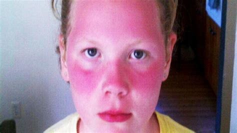 Bad Sunburn Face