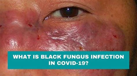 What Is Black Fungus Infection In Covid 19