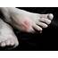 Itchy Rash On Top Of Foot Causes And Treatments  New Health Advisor