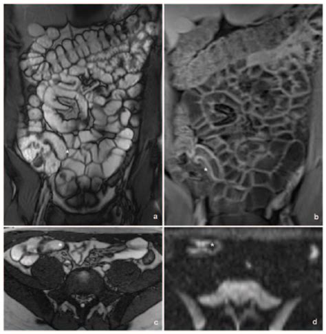 Mr Enterography Images Of A Terminal Ileitis In A 22 Year Old Man With