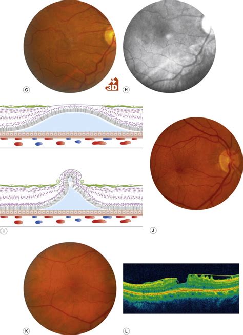 Macular Dysfunction Caused By Vitreous And Vitreoretinal Interface