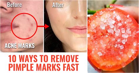 How To Remove Pimple Marks Naturally For Oily Skin Heidi Salon