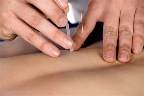 Do You Do Dry Needling Adelaide West Physio Pilates Headache Clinic