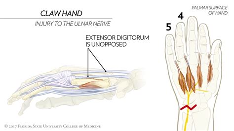 Hand Of Benediction Vs Ulnar Claw