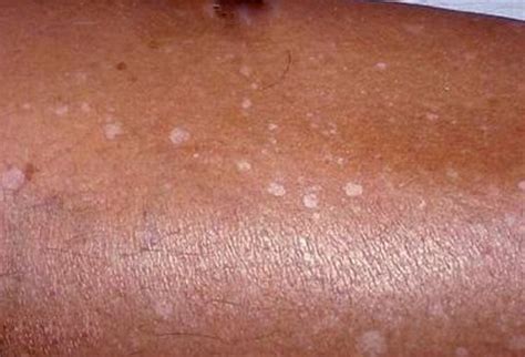 White Spots On Skin Pictures Causes Treatment