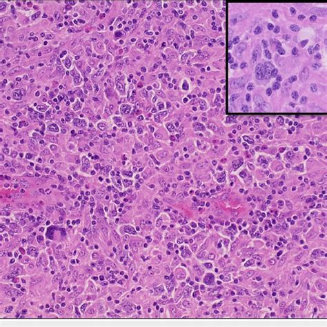Histology Of Left Axillary Lymph Node Excisional Biopsy Showed Hande X