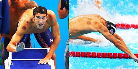 What Is Cupping What Are Those Circle Marks On Olympic Athletes
