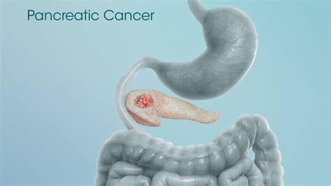 Read about pancreatic cancer symptoms, risk factors, related. A Rare Cancer That Killed Steve Jobs - Scientific Animations