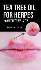 Herpes Holistic Cure Pictures