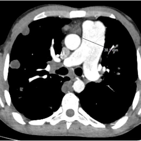 Axial Post Contrast Ct Scan Image Enlarged Pulmonary Trunk Main