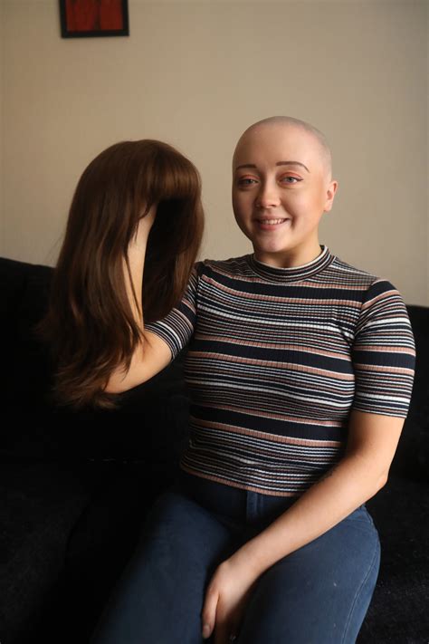 Dublin Teen Who Has Alopecia Reveals How Shaving Her Head Allowed Her