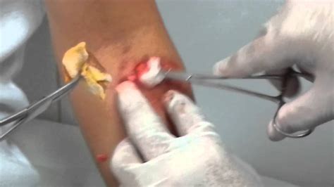 Cyst Removal From Forearm And One Stitch Youtube
