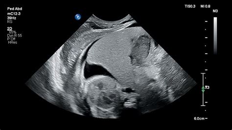 Pediatric Ultrasound Solution Philips Healthcare