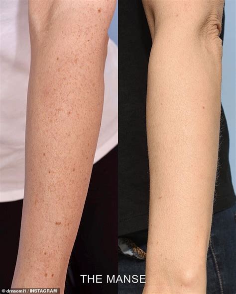 Cosmetic Surgeon Explains Why 690 Freckle Removal Treatments Are So