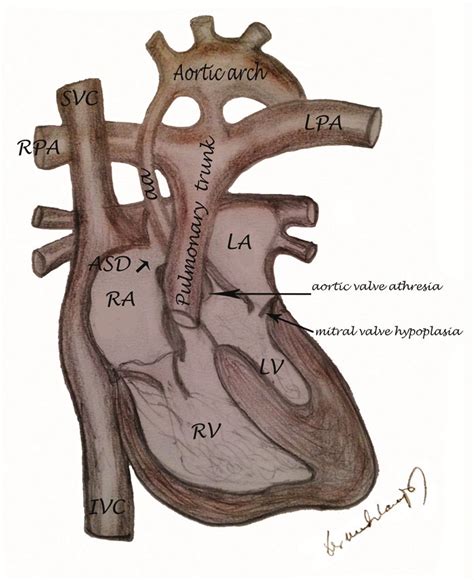 Schematic View Of Hypoplastic Left Heart Syndrome Aa Aortic Arch