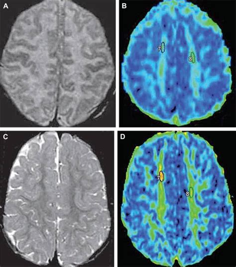 Diffusion Tensor Imaging For Evaluation Of The Childhood Brain And