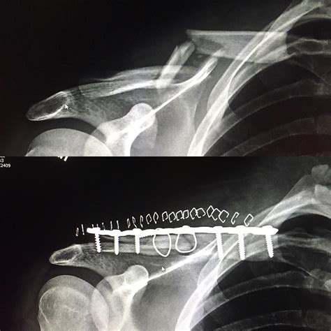 Broken Collarbone It Took One Metal Plate 6 Screws 23 Staples And