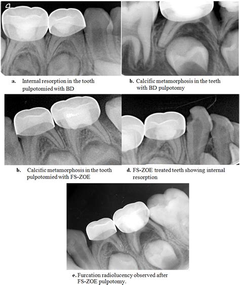 Figure 1 Periapical Radiographs Of Cases After A Follow Up Period Of