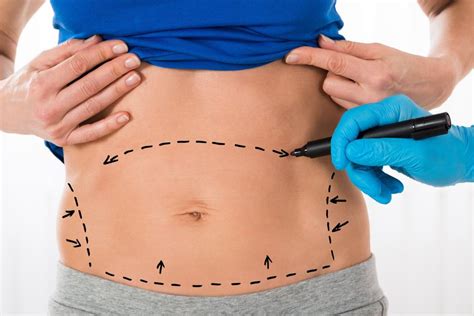 Beyond The Bulge The Science Behind Abdominoplasty And Muscle Repair