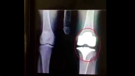 So I Broke My Knee Cap And Heres The X Ray Hurts Ohitsreal Youtube