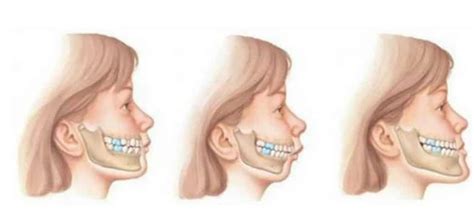 What Is A Malocclusion Central Coast Orthodontics