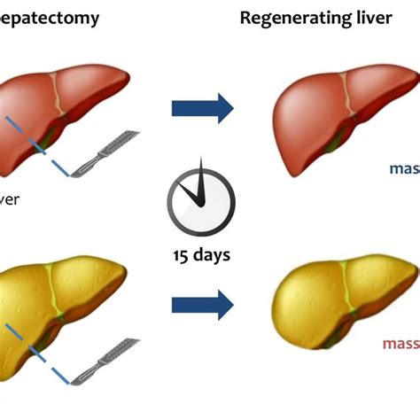 Lipid Metabolism Is Crucial For Liver Regeneration Fatty Liver Has An