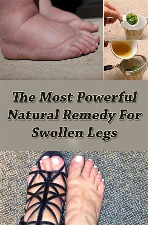 Powerful Natural Remedy For Swollen Legs Top 5 Diy Swollen Legs