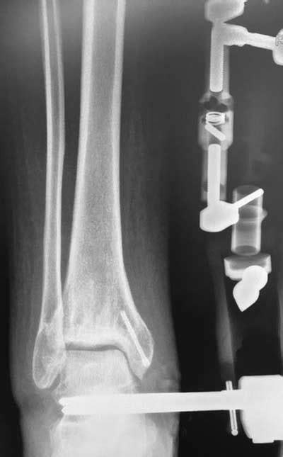 Intraoperative Ap X Ray Showing The Distraction Of The Ankle Joint
