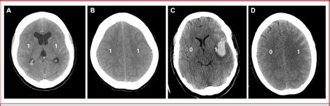 Figure 1 From The Subarachnoid Hemorrhage Early Brain Edema Score