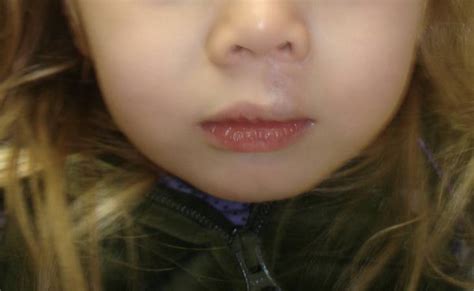 New York Lip Hemangioma Treatment Before And After Photos