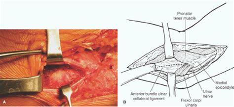 Ulnar Collateral Ligament Reconstruction Musculoskeletal Key