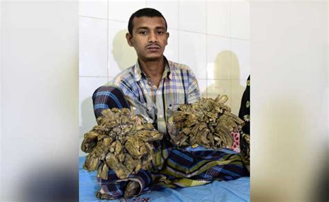 Surgery For Bangladeshs Tree Man To Remove Warts