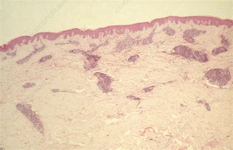 Erythema Annulare Centrifugum Light Micrograph Stock Image C055
