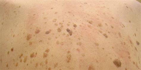 Seborrheic Keratosis Faq Vista Dermatology