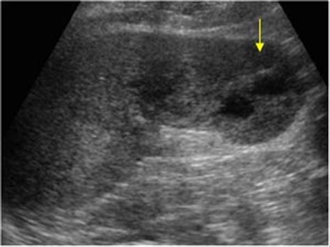 Abdomen And Retroperitoneum 14 Spleen Case 143 Splenic Infarcts
