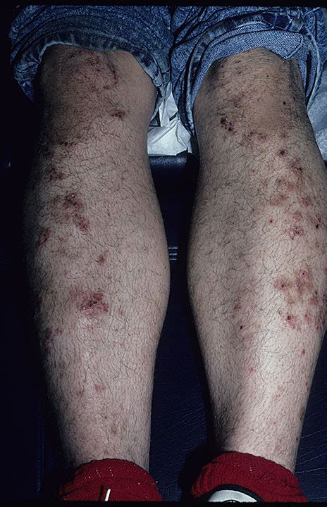 Dermatitis Herpetiformis Duhrings Disease التهاب الجلد العقبولي