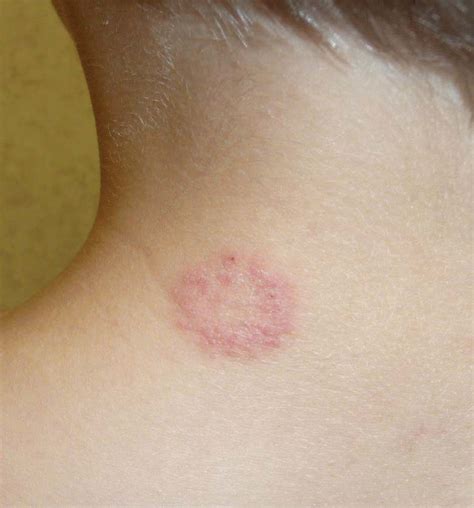An Itchy Round Rash On The Back Of An Adolescents Neck Consultant360