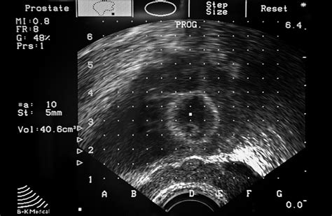 Transrectal Ultrasound Prostate Biopsy