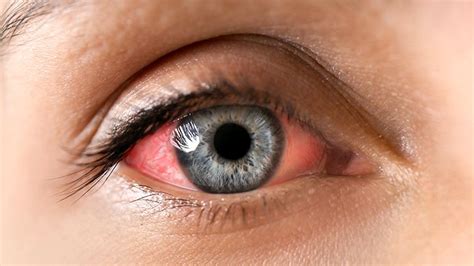 Does Psoriatic Arthritis Affect Eyes