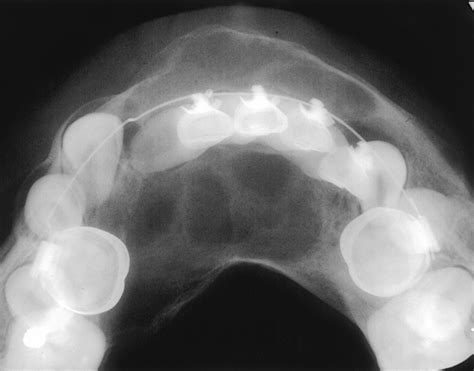 Cysts And Cystic Lesions Of The Mandible Clinical And Radiologic