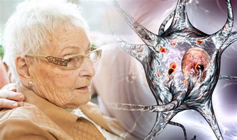 Dementia With Lewy Bodies Symptoms Six Signs Of The Disease Express