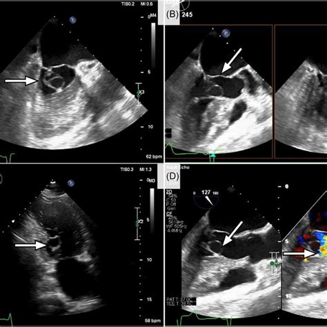 A‐d Echocardiographic Pictures Of A Rudimentary Mitral Valve Leaflet Download Scientific