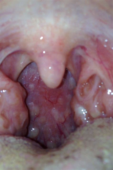 I Have White Spots At The Back Of My Throat And On My Tons