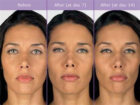 Do not take botox® if you: 92 best images about Botox on Pinterest | Medical spa, Botox injections and Plastic surgery