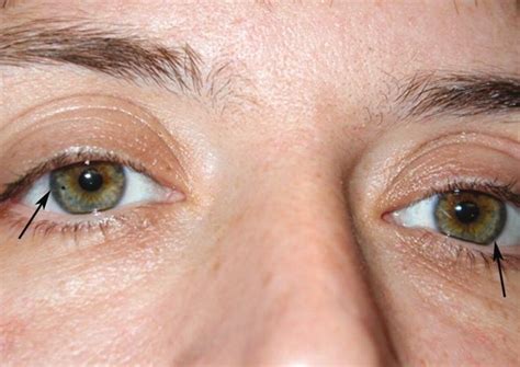 Wilson's disease: causes, symptoms, treatment and diagnosis