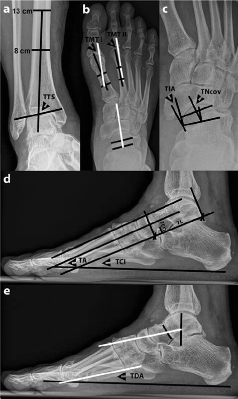 Weight Bearing Radiography Of A Patient With Varus Ankle Osteoarthritis