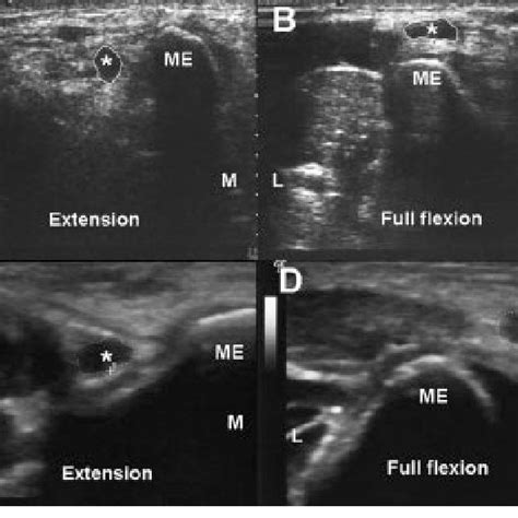 Transverse Sonograms Show Displacement Of The Ulnar Nerve During