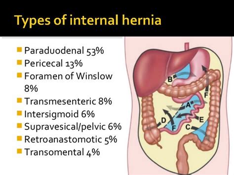 Internal Hernia